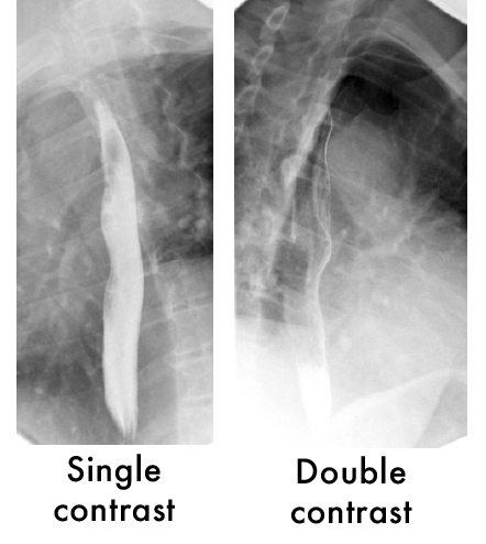 Single and double contrast example